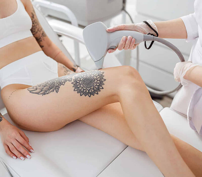 What are the three steps of tattoo removal? | by Clear Canvas | Medium